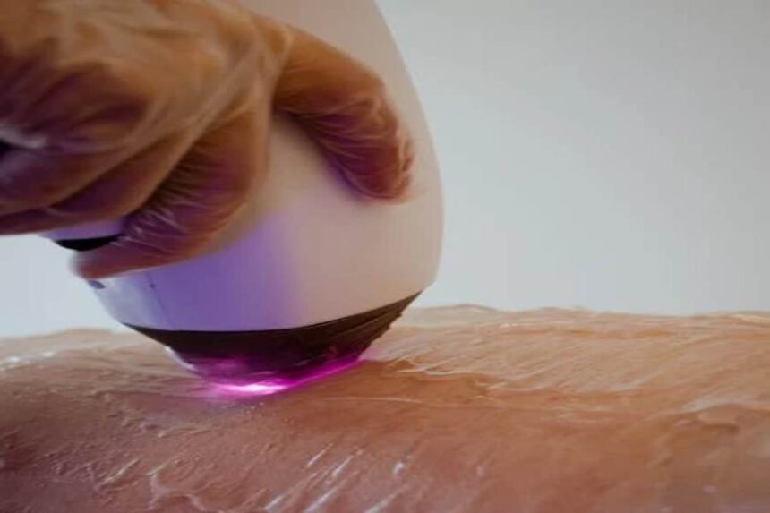 Why More Men Are Turning to Laser Hair Removal