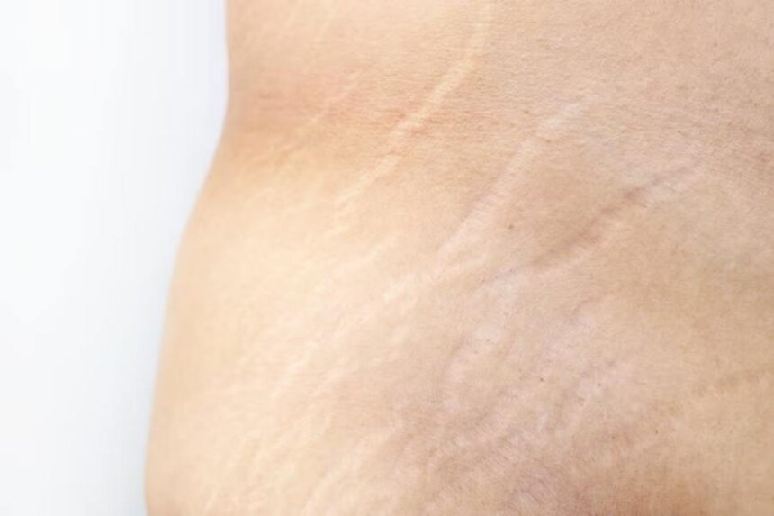 Stretch Marks on Thighs