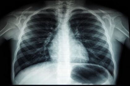 Understanding Scoliosis