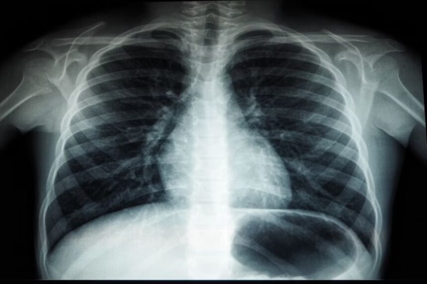 Understanding Scoliosis